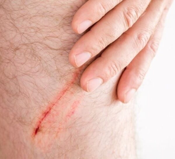 Luka yang Tak Terlihat_alineaku